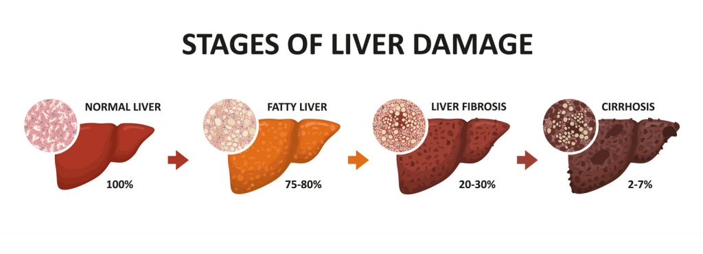 Stages of Liver Damage